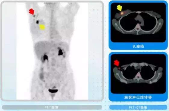 外国早期筛查癌症,petct用于诊断癌症