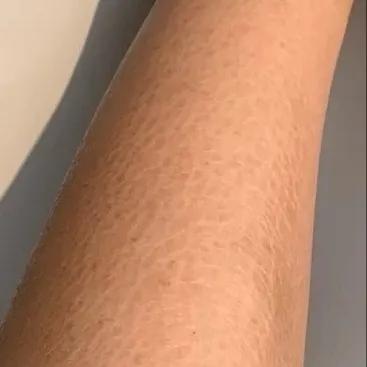 又到了穿小裙的季节，鸡皮女孩该怎么办……