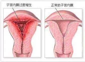 停经后子宫内膜增厚,子宫内膜增厚是癌吗