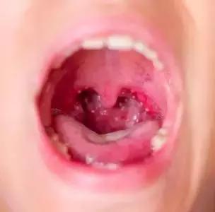 小孩鹅口疮和口腔溃疡的区别,鹅口疮跟口腔溃疡怎么区分