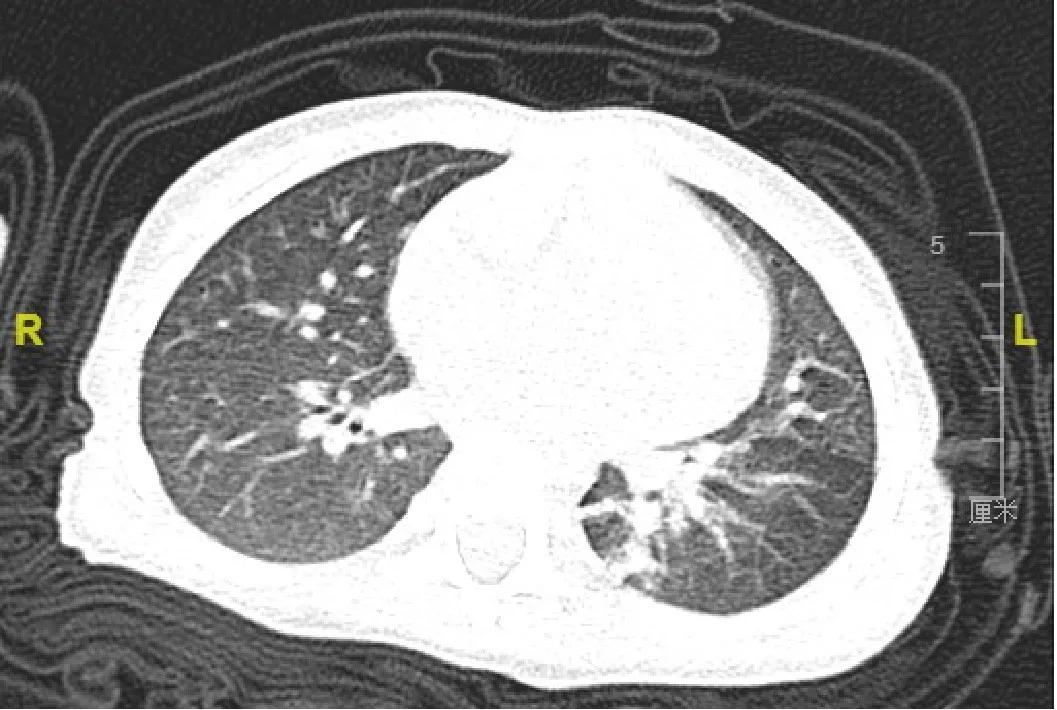 肺炎治不好会怎么样,肺炎治不好怎么办
