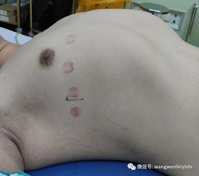 胸围超1米：重度桶状胸，Wenlin手术