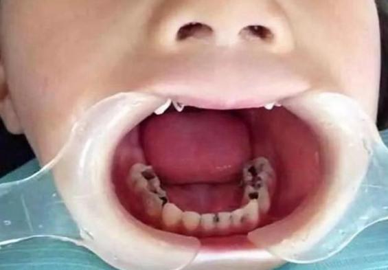 四岁孩子牙黑怎么回事,小孩满口黑牙不是吃糖是父母无知