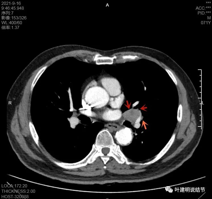 肺上有实性结节6mmx5mm是什么原因,肺上有1.7x1.8的实性结节该怎么办