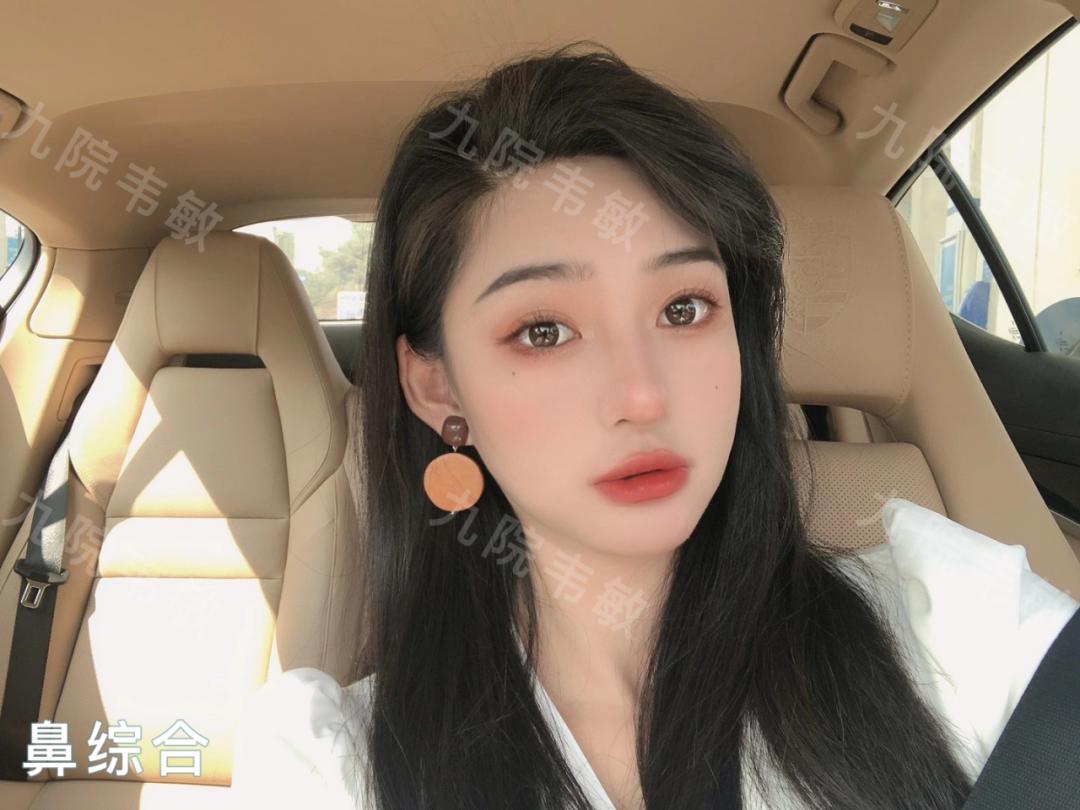 耳软骨垫鼻尖膨体垫鼻梁,膨体做鼻梁和鼻尖