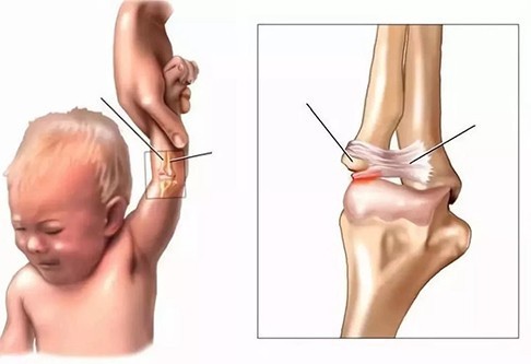孩子胳膊脱臼好几次是怎么回事,孩子胳膊脱臼什么原因