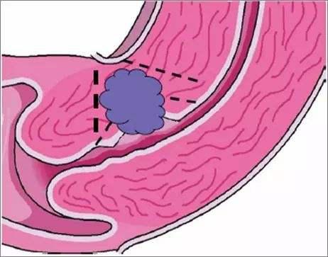 这种特殊的异位妊娠,你听过么?
