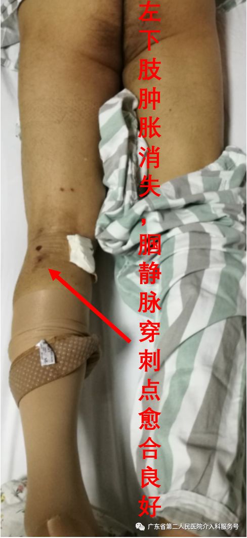 左腿血栓的最快消除方法,左腿浮肿有血栓用什么药治疗