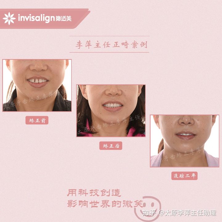 太原市牙齿正畸,太原市口腔正畸