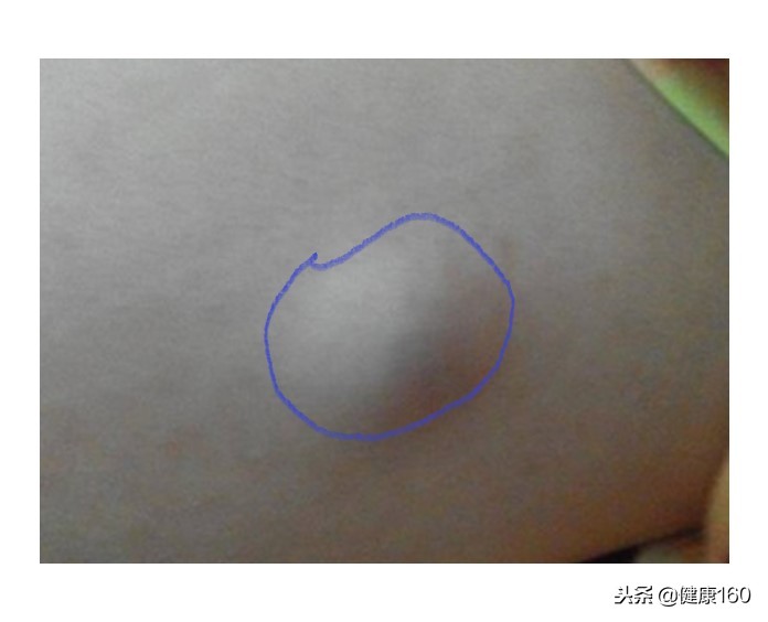 皮肤起小肉球怎么回事,大腿皮肤下面有个小肉球