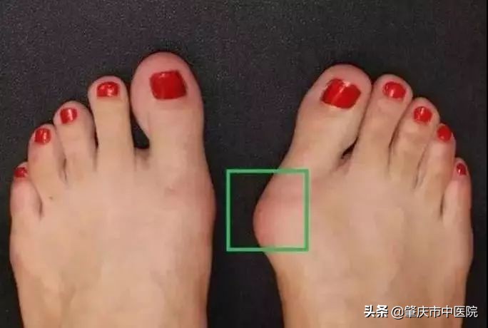 原来脚拇趾外翻是一种病，“元凶”竟是经常穿这种鞋有关！听听市中医院骨伤科专家怎么说……