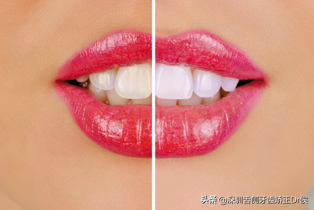 牙齿美白最好的方法价格,牙齿美白对牙齿有伤害吗