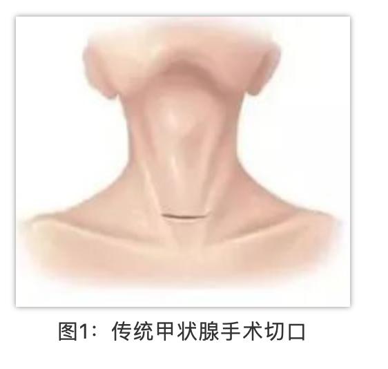 做甲状腺留疤怎么办,做甲状腺手术有哪些危险