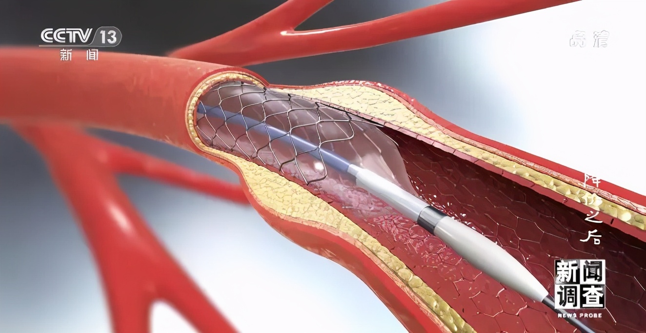 支架降价没,支架降价后有些医生开始滥用球囊