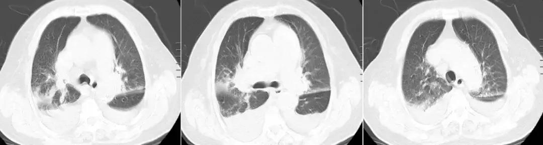 病人无法脱离插管呼吸机,病人无法脱离呼吸机如何转院