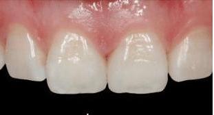 门牙缝可以补吗,门牙有缝怎么办如何补救