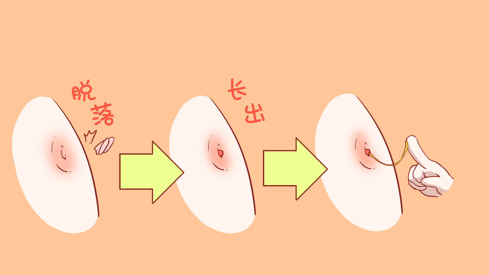 宝宝肚脐里有肉芽发脓,婴儿肚脐长肉芽用碘伏消毒变小了