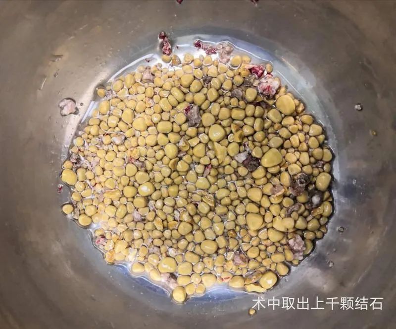 东莞市南城医院发现“结石王”1258颗！装了一盆