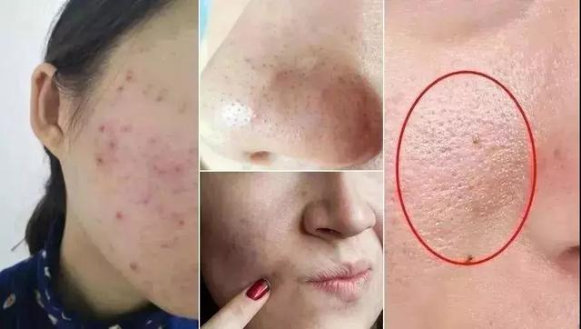 李佳琦推荐控油祛痘除螨洗脸皂,李佳琦推荐洗面奶祛黑头粉刺