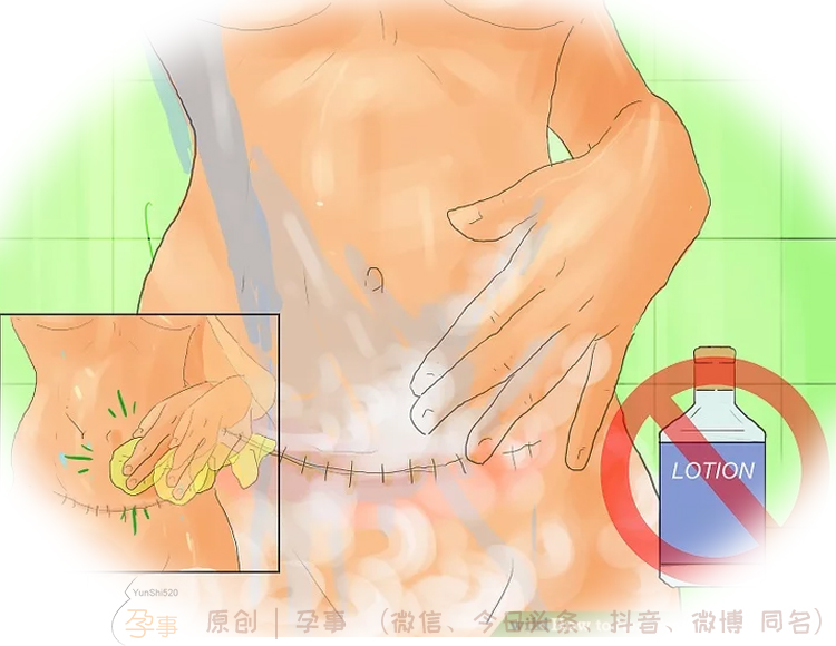 剖腹产妈妈多久可以完全恢复,剖腹产如何恢复得快一些