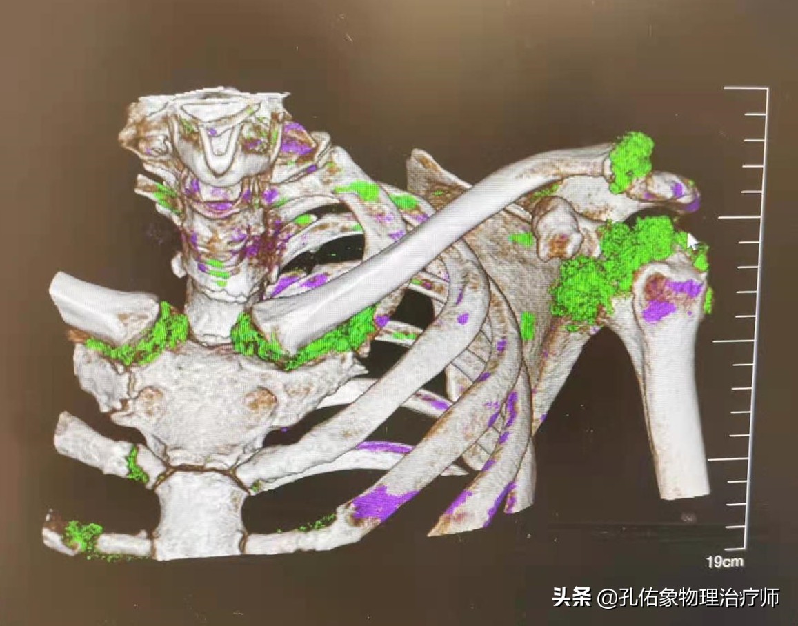 肩膀疼痛什么原因中医辨证治疗,整天肩膀酸痛怎么检查病因