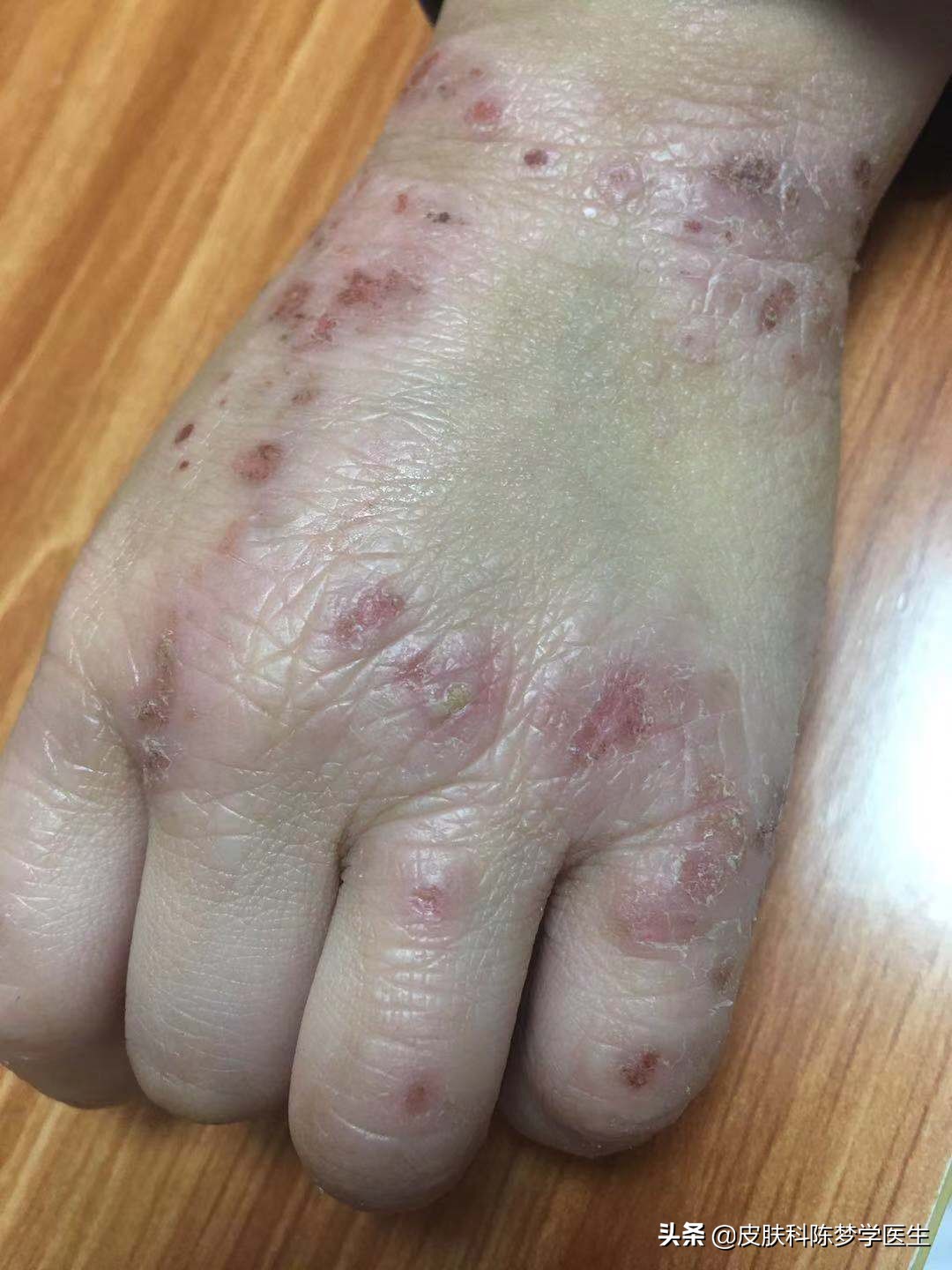 湿疹了吃什么药,如果你得了湿疹怎么办