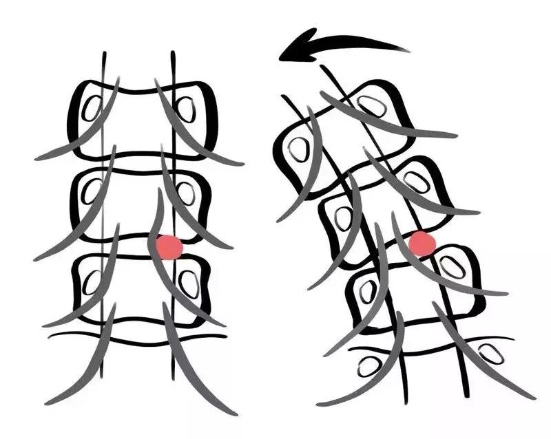 腰突脊柱侧弯最好的恢复方法,腰突为什么会引起侧弯