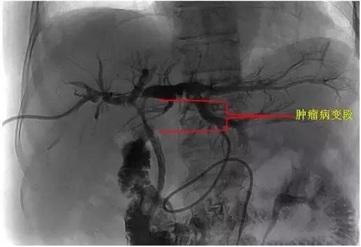 胆管下段良性肿瘤手术治疗方法,恶性肿瘤小肠梗阻介入治疗