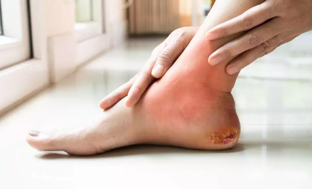 自体干细胞移植治疗糖尿病足费用,干细胞治疗1型糖尿病的最新进展