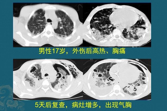 化脓性肺炎，硬扛3天不吃抗生素必后悔，这个细菌专治各种不服