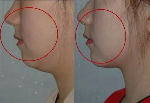 三个动作甩掉下巴赘肉,三秒消除双下巴