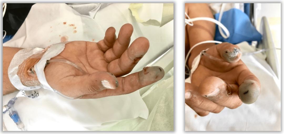 氢氟酸的危害有多可怕,氢氟酸的危害到底有多大