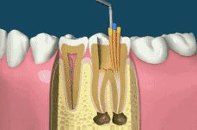 你们做根管治疗花了多少钱,根管治疗做了真的有用吗