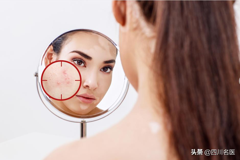 华西医院治疗痘印痘坑怎么样,四川华西皮肤科脸上长痘怎么治疗