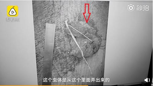 小孩眼睛里长阴虱,4岁小孩睫毛长满阴虱瘙痒难忍