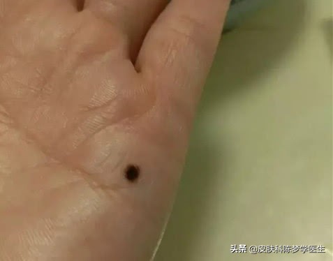 脸上长很多痣是好还是坏,脸上痣发炎红肿是癌变吗