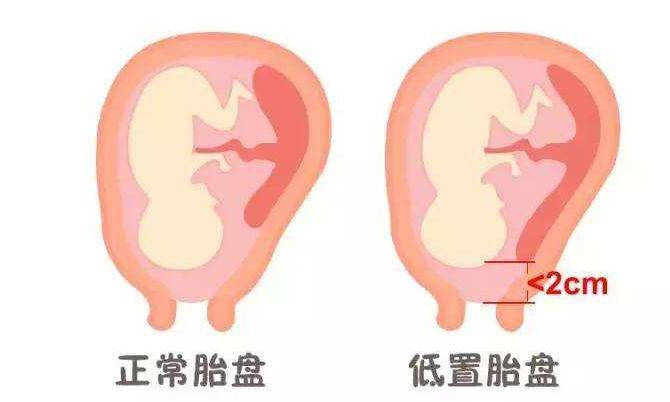 胎盘低置不可怕，孕妇想要胎盘长上去，孕期做好这6点