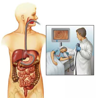 做普通胃镜肠镜的真实感受,做了胃肠镜还有必要做胃镜吗