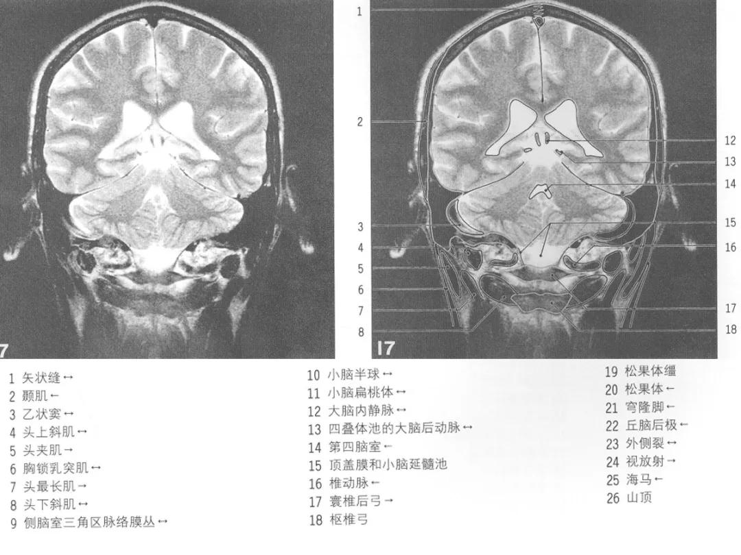 颅脑冠状状切面解剖图,颅脑mr解剖结构图
