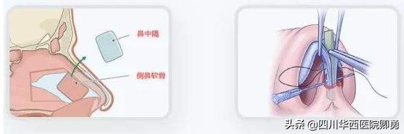 鼻中隔软骨和超肋隆鼻哪个好,耳软骨加鼻中隔隆鼻价格多少