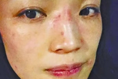 舒淇过敏原因,舒淇过敏脸是怎么好的