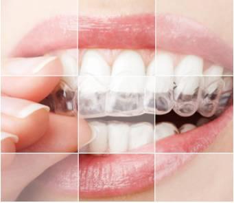 矫正牙齿打骨钉疼不疼,小孩矫正牙齿疼不疼