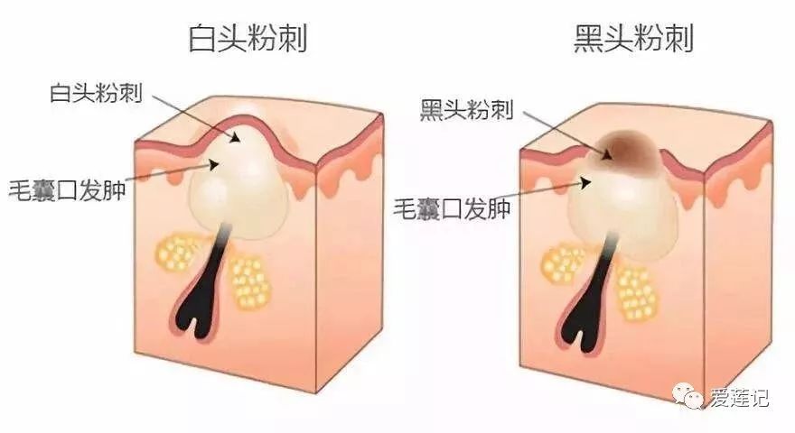 25岁还长痘去医院怎么治,40岁长痘的原因和护理方法