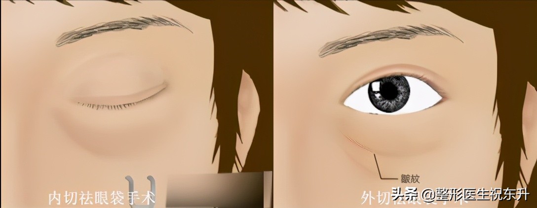 做眼袋手术的说说,关于眼袋手术的一些知识