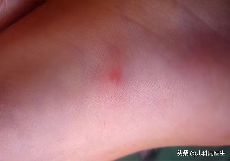 春天起水痘,如何辨别水痘和麻疹