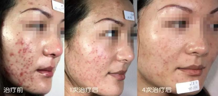 抗过敏祛红血丝,50岁过敏皮肤去红血丝最有效