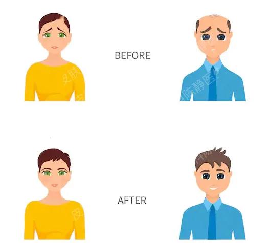 米诺地尔脱发女士专用,米诺地尔对于m型脱发非常有效果