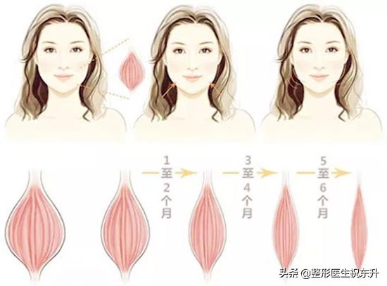 经常打除皱针会不会加速衰老,打除皱针后期会加速衰老吗