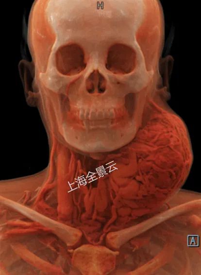 颈部肿块为什么有80%是肿瘤,颈部肿块1年没有变化