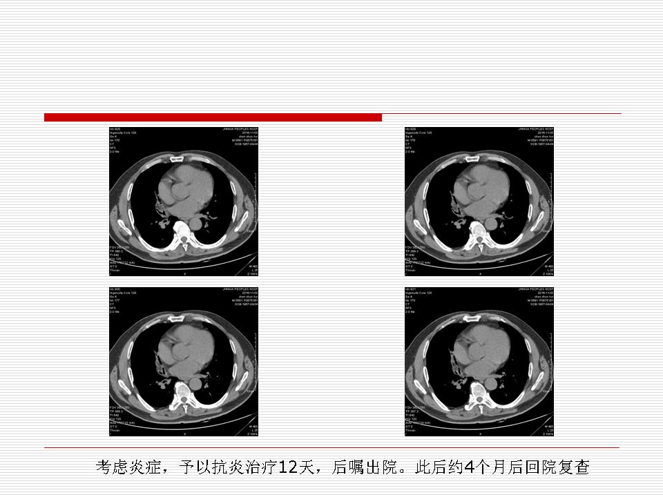 像炎症的肺癌能治好吗,医生说可能是肺癌也可能是炎症